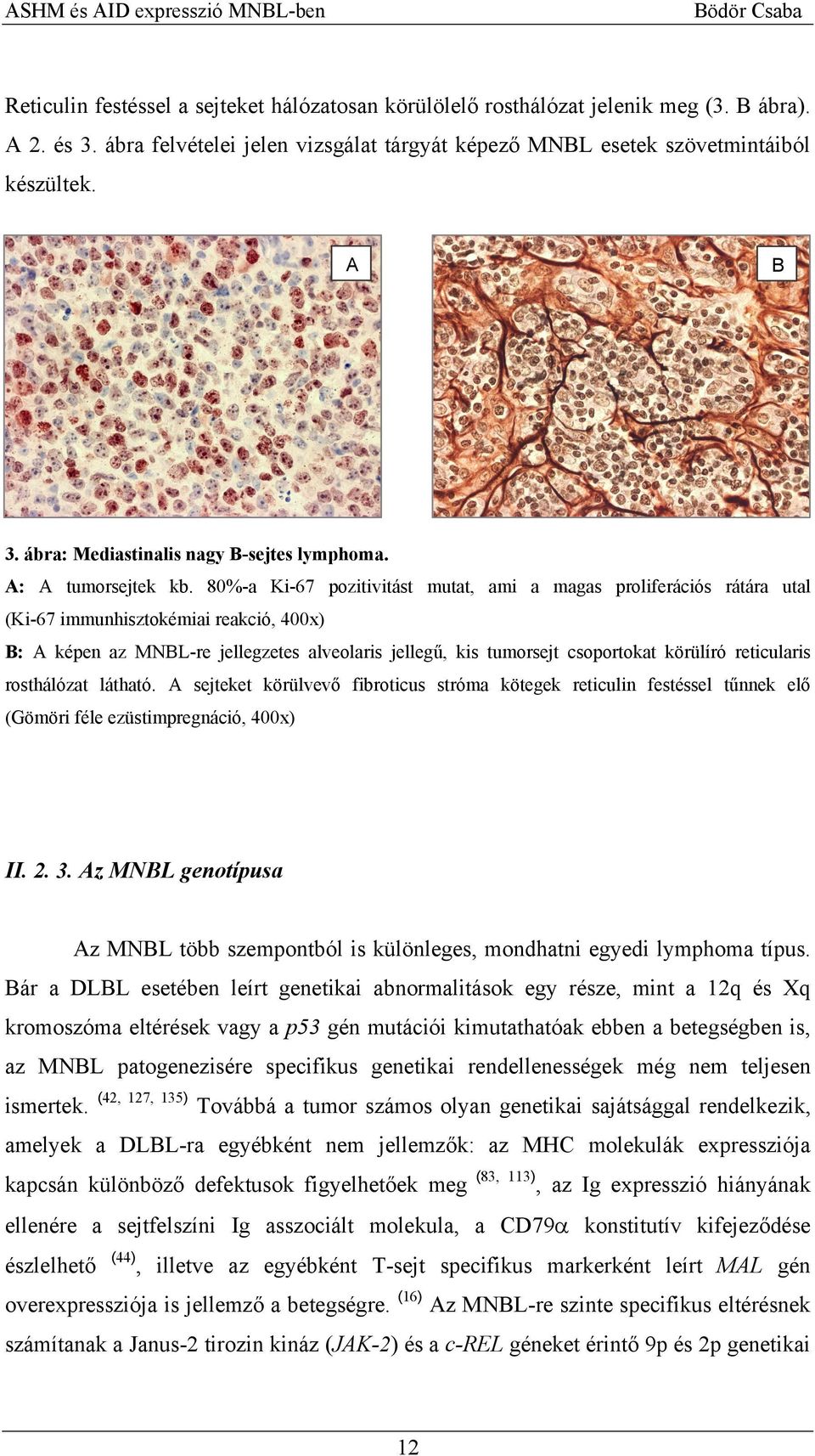 80%-a Ki-67 pozitivitást mutat, ami a magas proliferációs rátára utal (Ki-67 immunhisztokémiai reakció, 400x) B: A képen az MNBL-re jellegzetes alveolaris jellegű, kis tumorsejt csoportokat körülíró