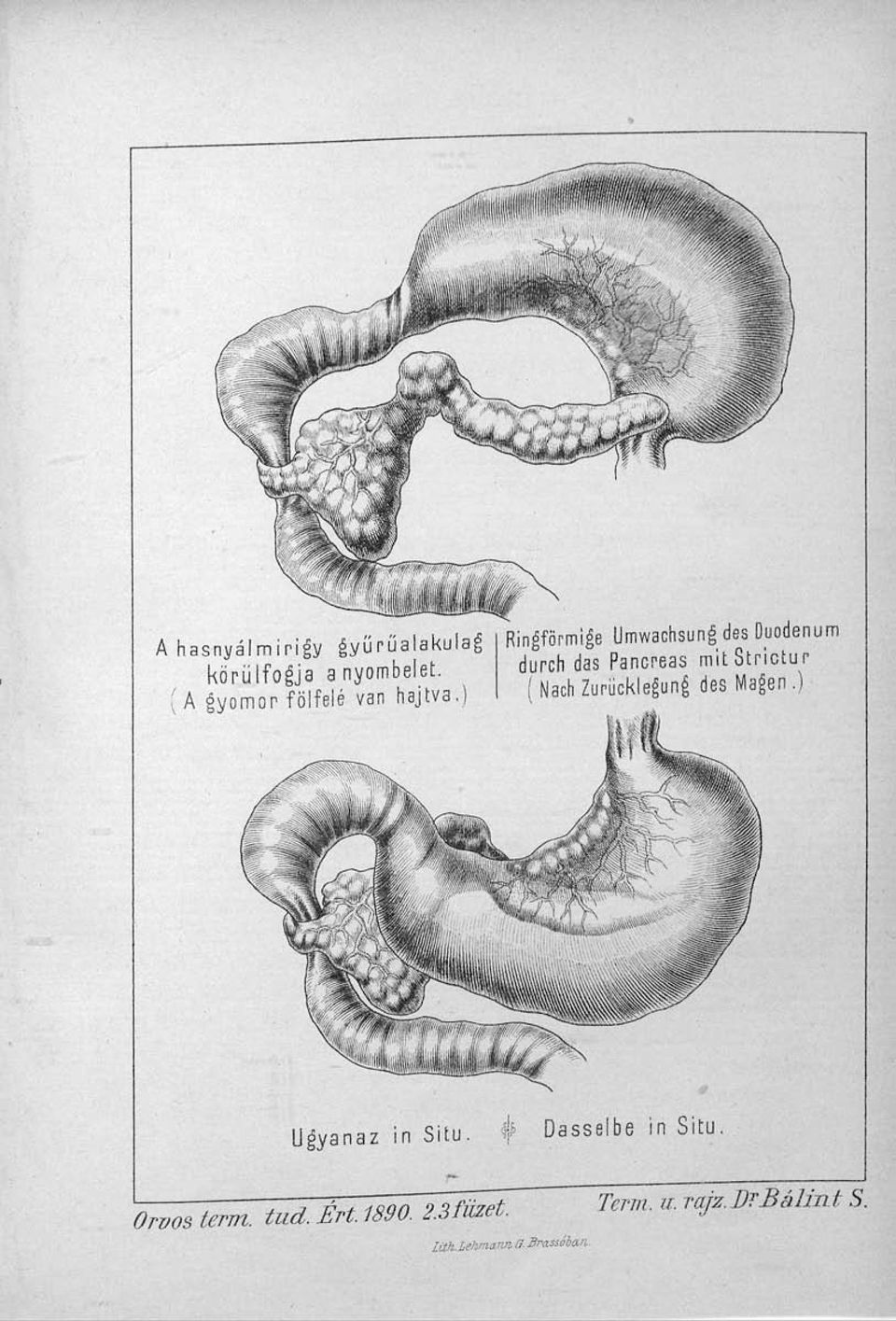 ) Ringförmige Umwachsung des Duodenum durch das Pancreas mit Strictur ( Nach