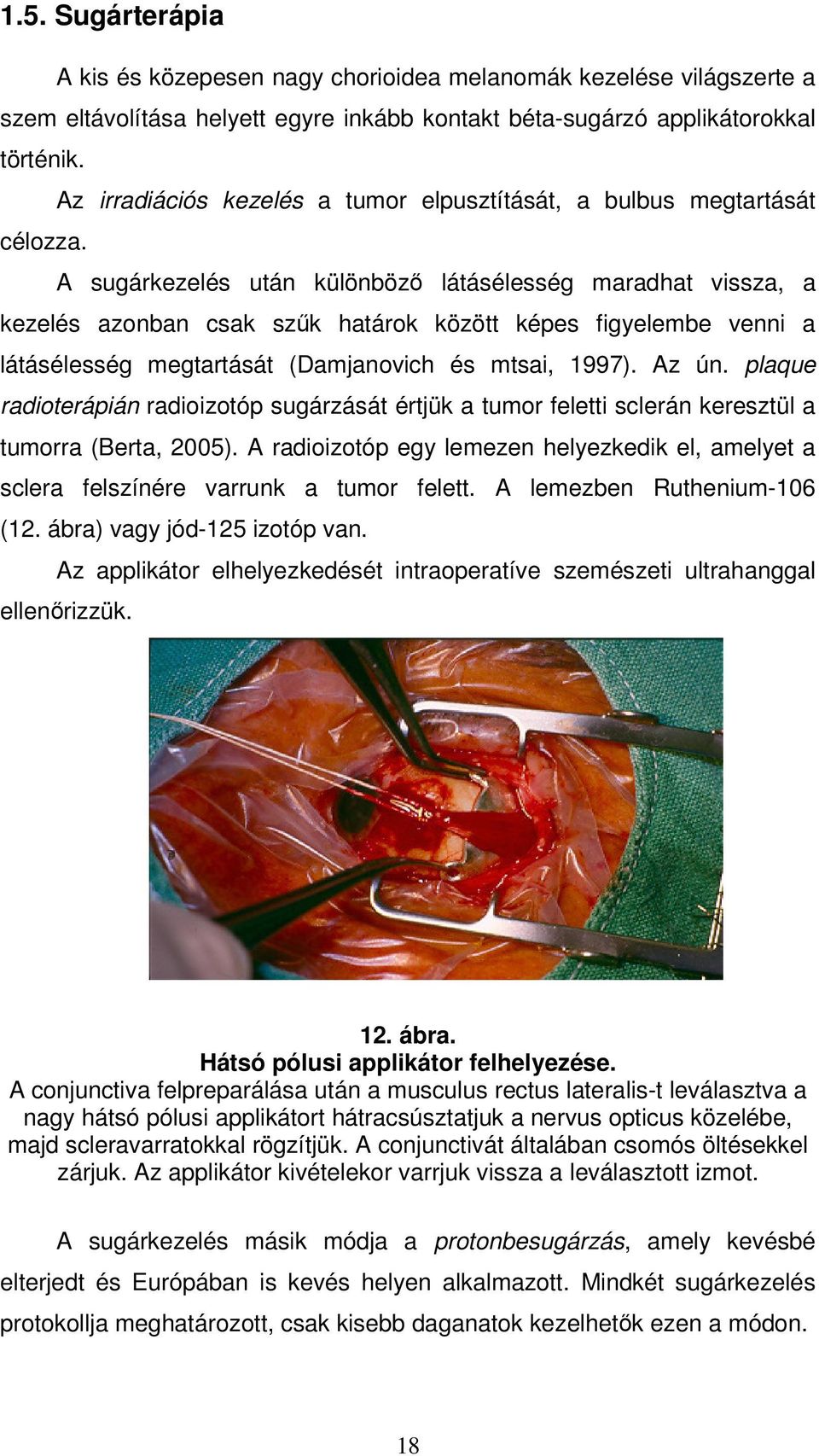 A sugárkezelés után különbözı látásélesség maradhat vissza, a kezelés azonban csak szők határok között képes figyelembe venni a látásélesség megtartását (Damjanovich és mtsai, 1997). Az ún.