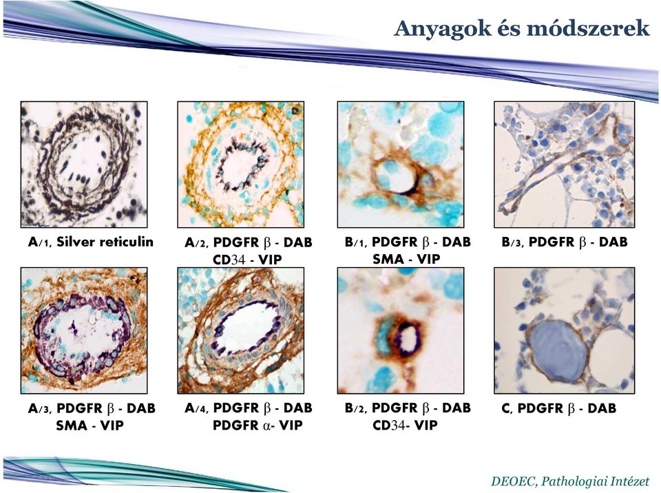 β - DAB A/3, PDGFR β - DAB SMA - VIP A/4, PDGFR β - DAB