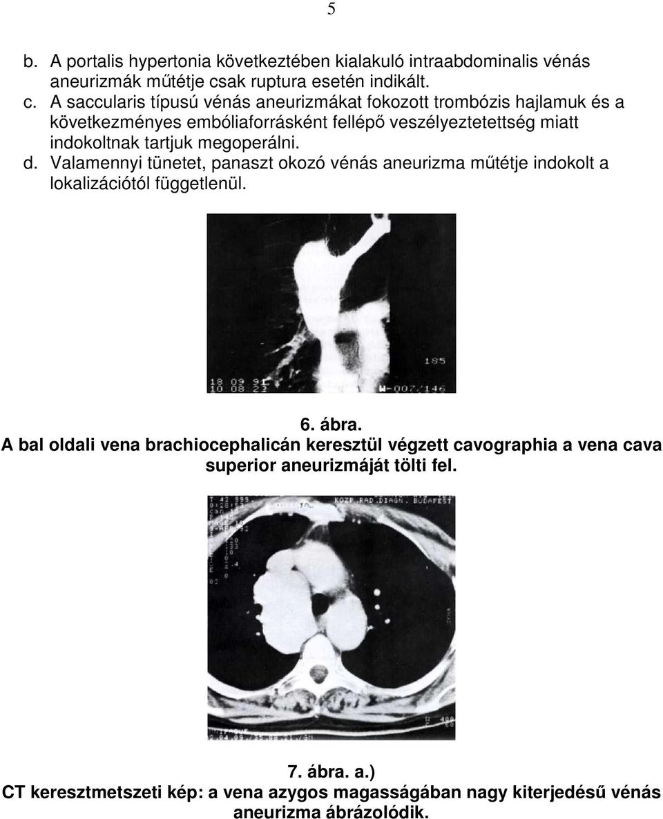 A saccularis típusú vénás aneurizmákat fokozott trombózis hajlamuk és a következményes embóliaforrásként fellépı veszélyeztetettség miatt indokoltnak