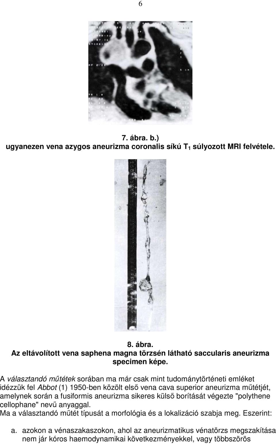 során a fusiformis aneurizma sikeres külsı borítását végezte "polythene cellophane" nevő anyaggal.