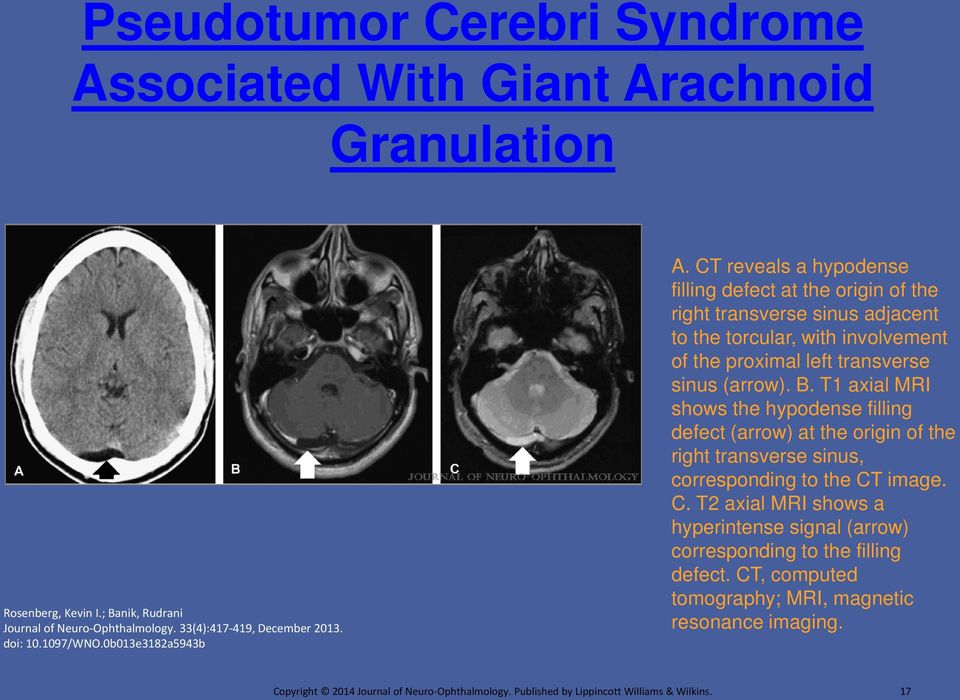 CT reveals a hypodense filling defect at the origin of the right transverse sinus adjacent to the torcular, with involvement of the proximal left transverse sinus (arrow). B.