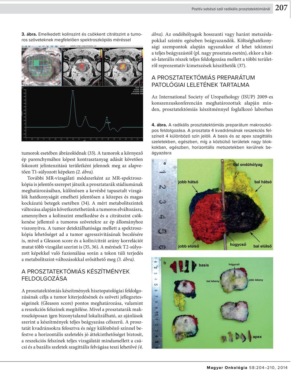 nagy prosztata esetén), ekkor a hátsó-laterális részek teljes feldolgozása mellett a többi területről reprezentatív kimetszések készíthetők (37).