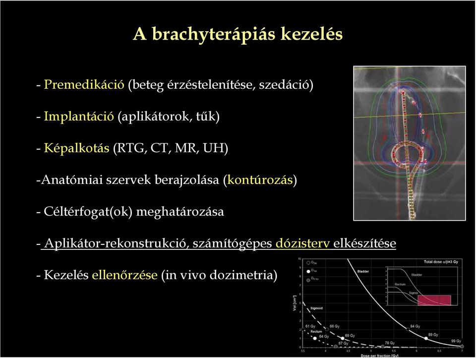 szervek berajzolása (kontúrozás) - Céltérfogat(ok) meghatározása -