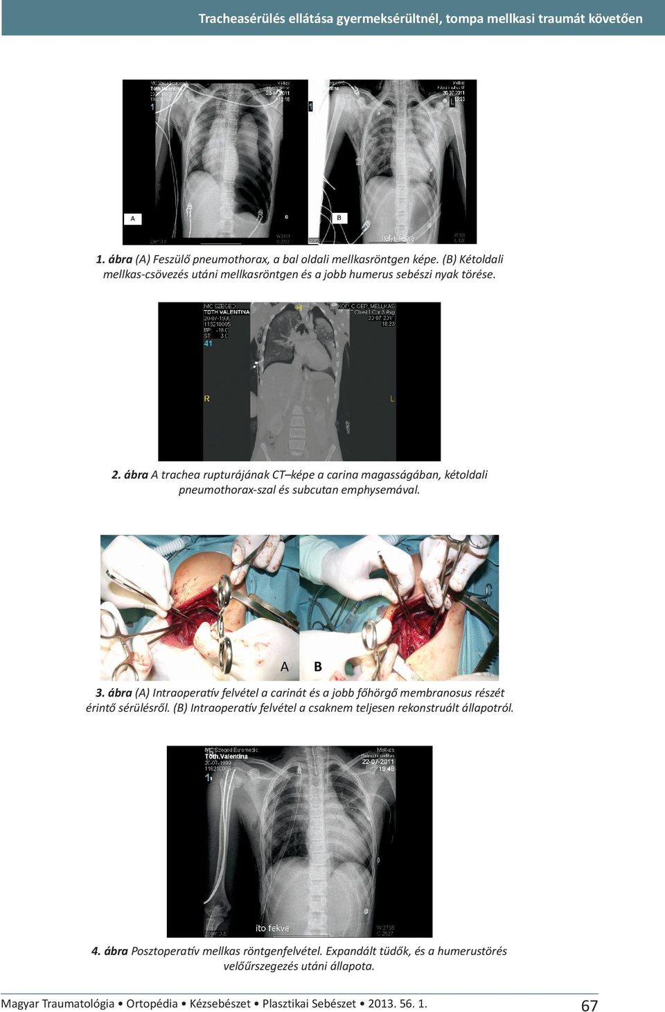 ábra A trachea rupturájának CT képe a carina magasságában, kétoldali pneumothorax-szal és subcutan emphysemával. 3.