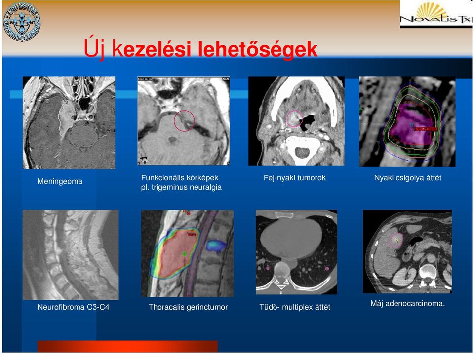 trigeminus neuralgia Fej-nyaki tumorok Nyaki