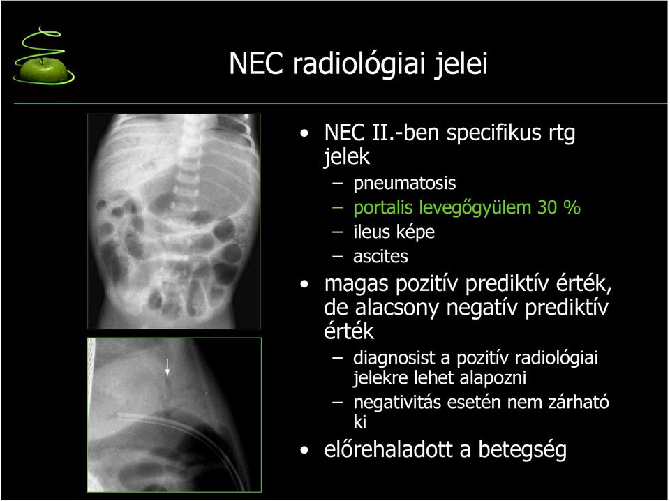 képe ascites magas pozitív prediktív érték, de alacsony negatív prediktív