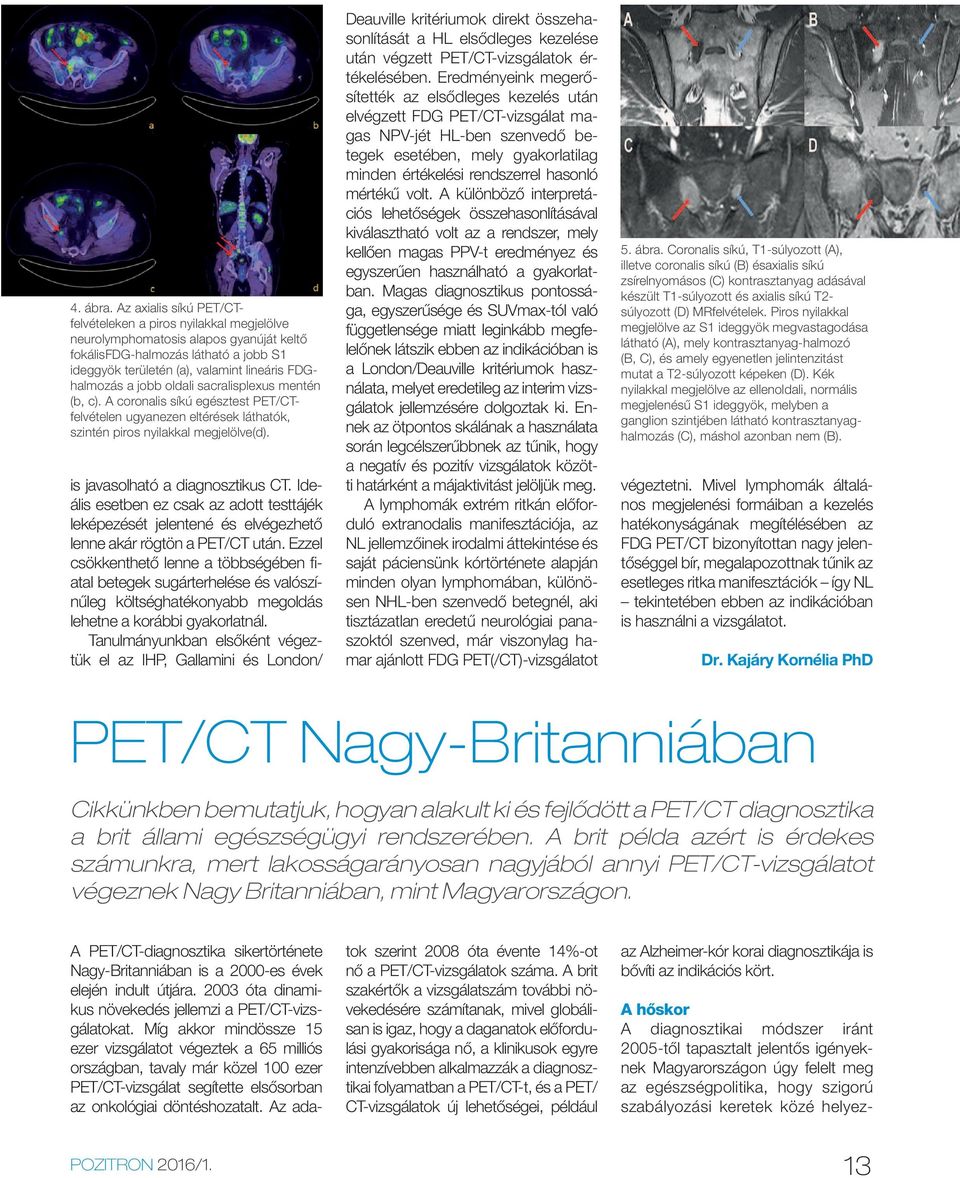 jobb oldali sacralisplexus mentén (b, c). A coronalis síkú egésztest PET/CTfelvételen ugyanezen eltérések láthatók, szintén piros nyilakkal megjelölve(d). is javasolható a diagnosztikus CT.