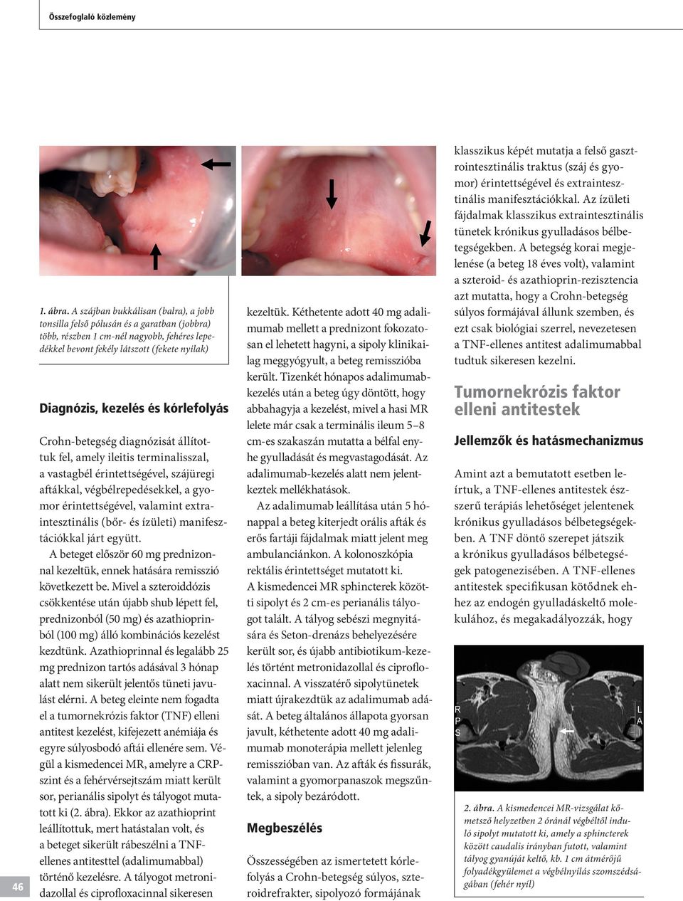 kórlefolyás Crohn-betegség diagnózisát állítottuk fel, amely ileitis terminalisszal, a vastagbél érintettségével, szájüregi aftákkal, végbélrepedésekkel, a gyomor érintettségével, valamint