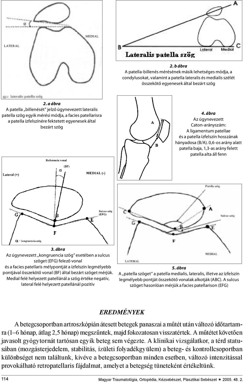 ábra Az úgynevezett Caton-arányszám: A ligamentum patellae és a patella ízfelszín hosszának hányadosa (B/A). 0,6-os arány alatt patella baja, 1,3-as arány felett patella alta áll fenn 3.