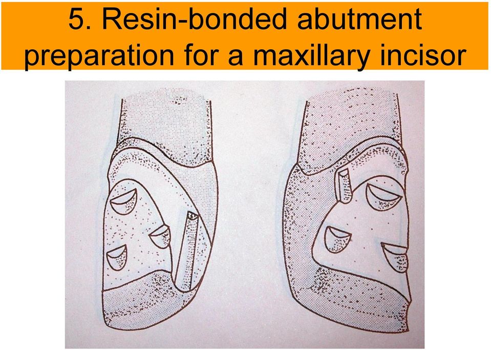 abutment