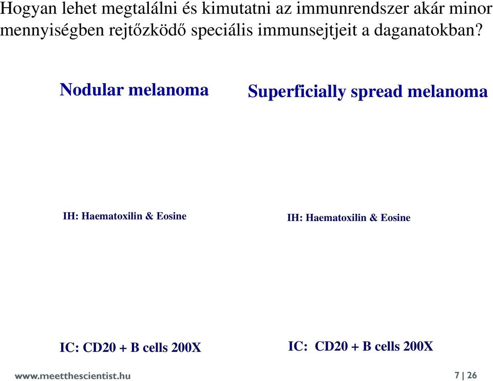 Nodular melanoma Superficially spread melanoma IH: Haematoxilin & Eosine