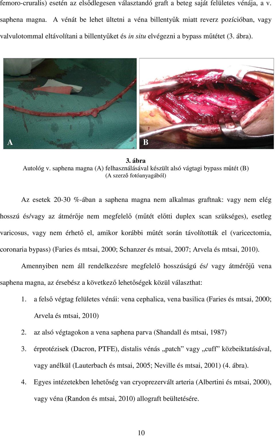 saphena magna (A) felhasználásával készült alsó vágtagi bypass műtét (B) (A szerző fotóanyagából) Az esetek 20-30 %-ában a saphena magna nem alkalmas graftnak: vagy nem elég hosszú és/vagy az