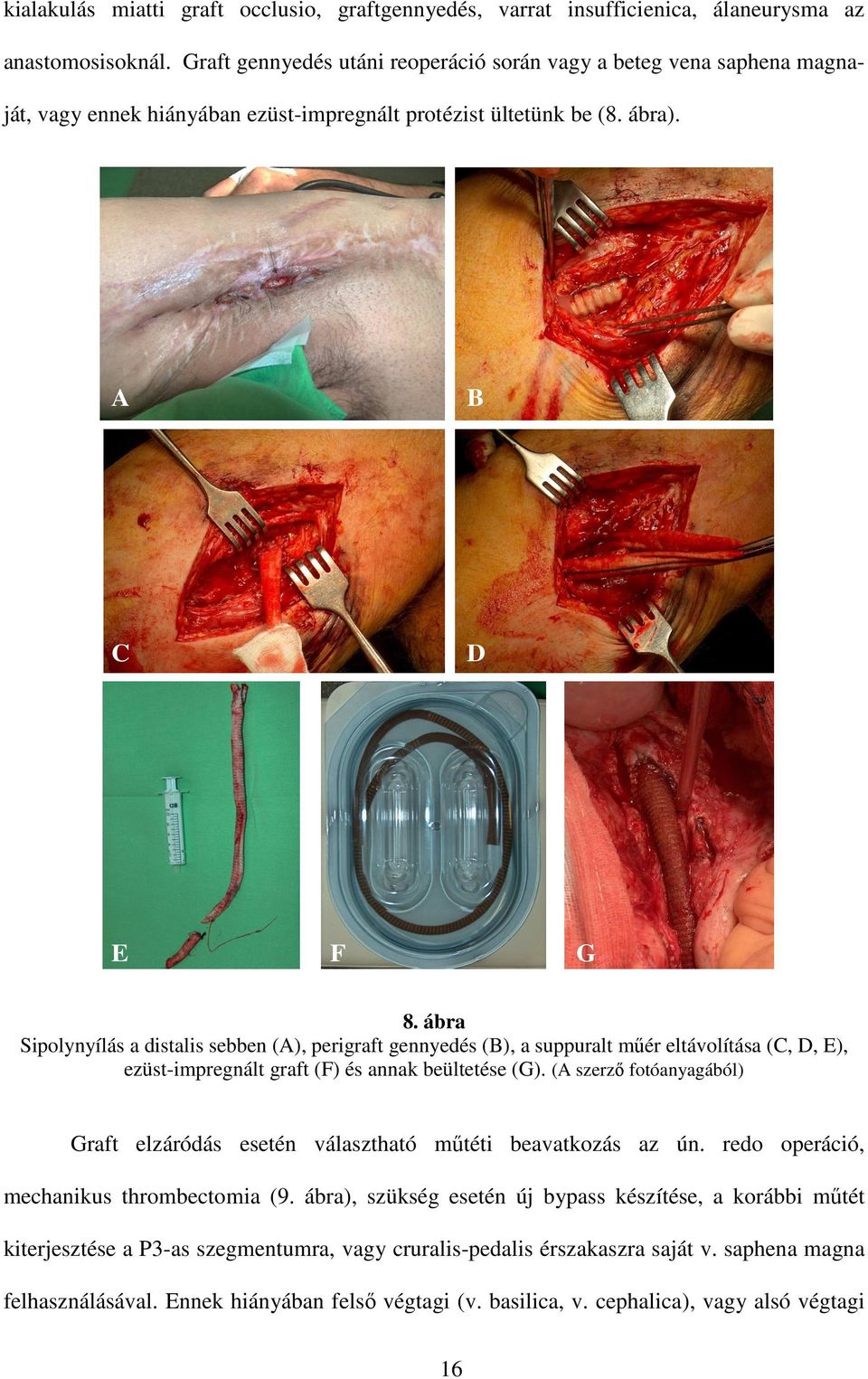 ábra Sipolynyílás a distalis sebben (A), perigraft gennyedés (B), a suppuralt műér eltávolítása (C, D, E), ezüst-impregnált graft (F) és annak beültetése (G).