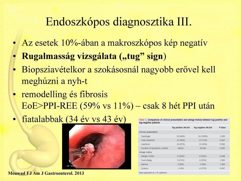 sign) Biopsziavételkor a szokásosnál nagyobb erővel kell meghúzni a nyh-t