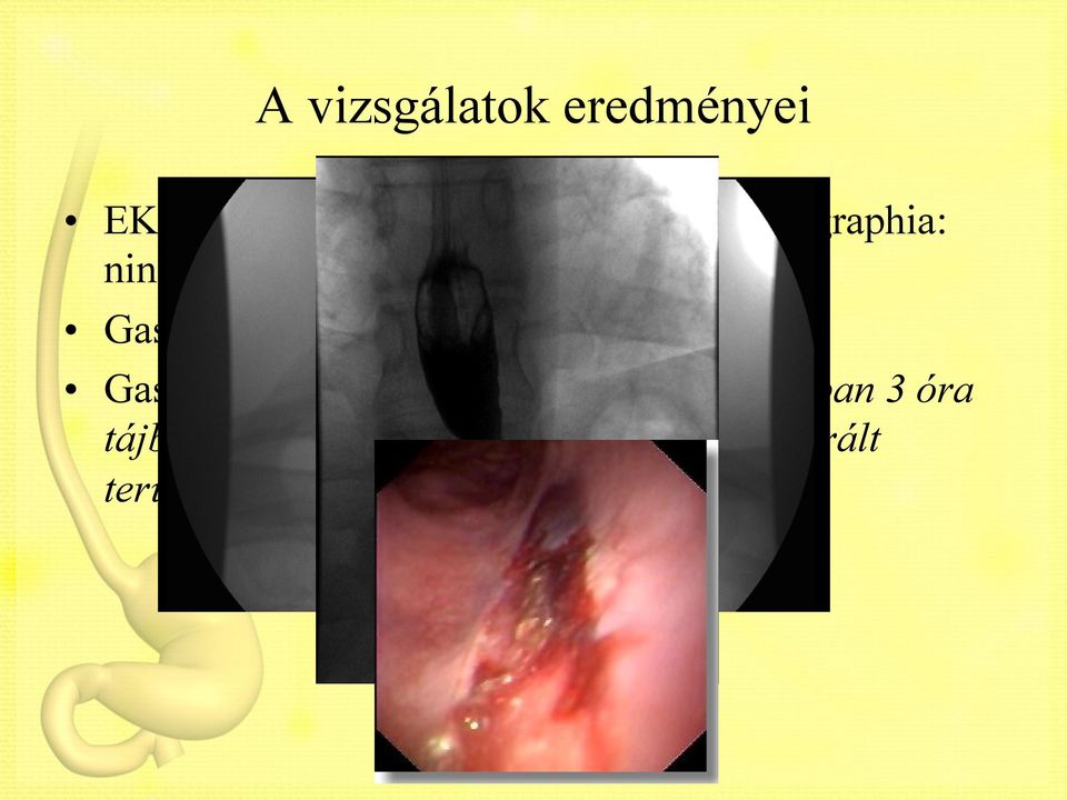 nyelésvizsgálat: negatív Gastroscopia: nyelőcső középső