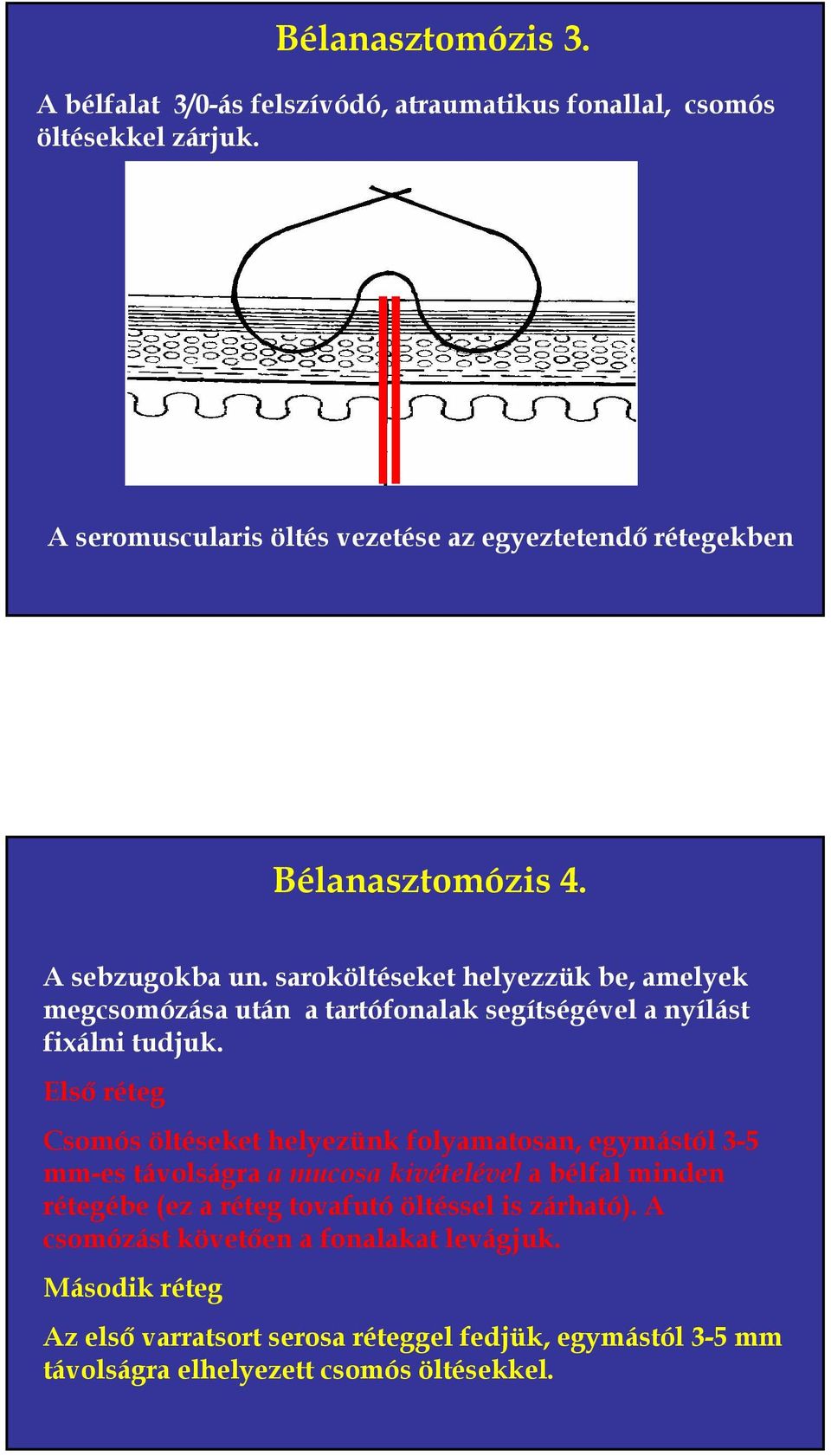 saroköltéseket helyezzük be, amelyek megcsomózása után a tartófonalak segítségével a nyílást fixálni tudjuk.