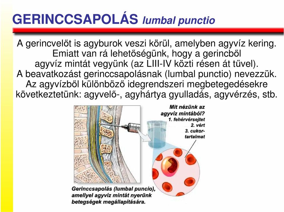 át tővel). A beavatkozást gerinccsapolásnak (lumbal punctio) nevezzük.