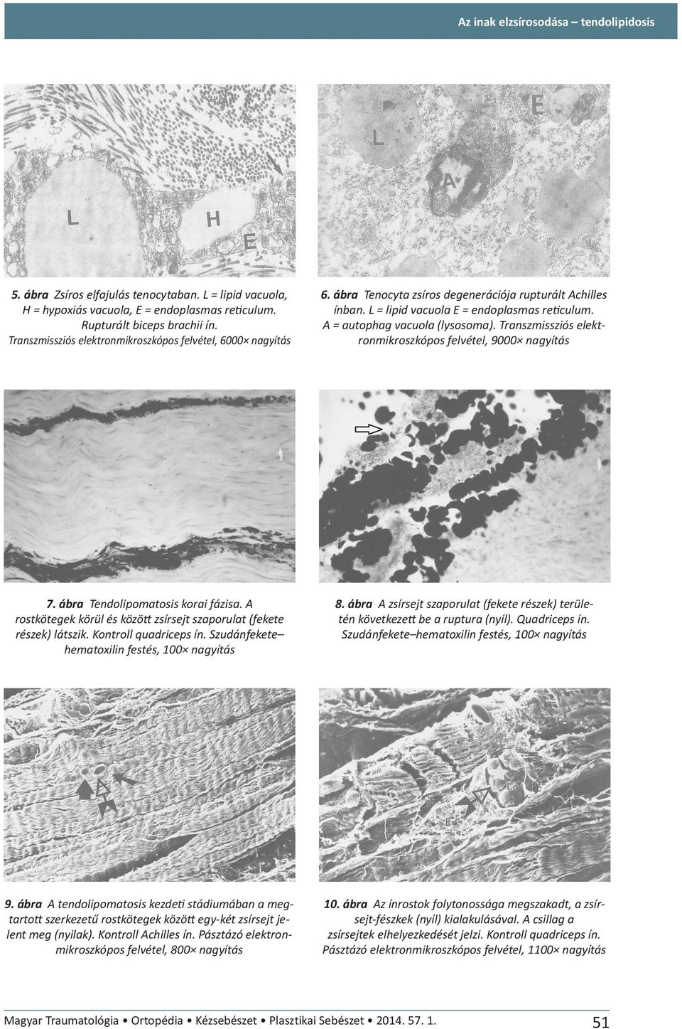 A = autophag vacuola (lysosoma). Transzmissziós elektronmikroszkópos felvétel, 9000 nagyítás 7. ábra Tendolipomatosis korai fázisa.