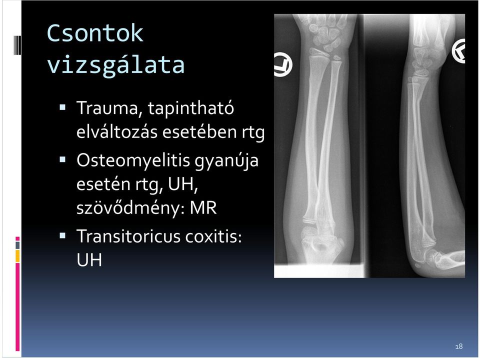 Osteomyelitisgyanúja esetén rtg,