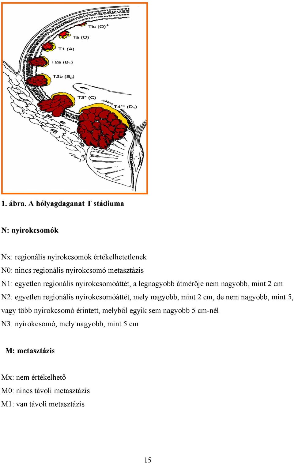 metasztázis N1: egyetlen regionális nyirokcsomóáttét, a legnagyobb átmérője nem nagyobb, mint 2 cm N2: egyetlen regionális
