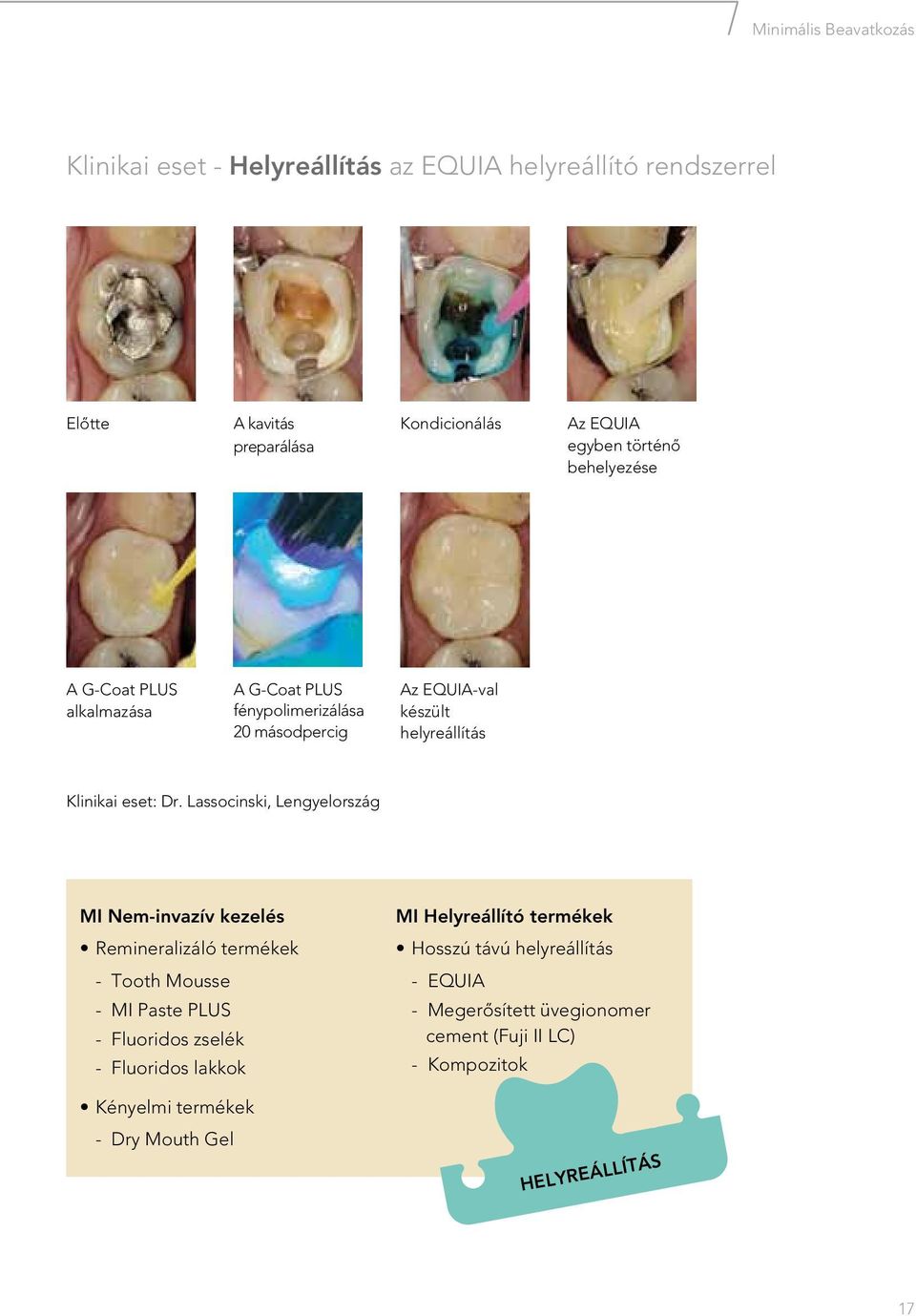 Lassocinski, Lengyelország MI Nem-invazív kezelés Remineralizáló termékek - Tooth Mousse - MI Paste Plus - Fluoridos zselék - Fluoridos lakkok Kényelmi
