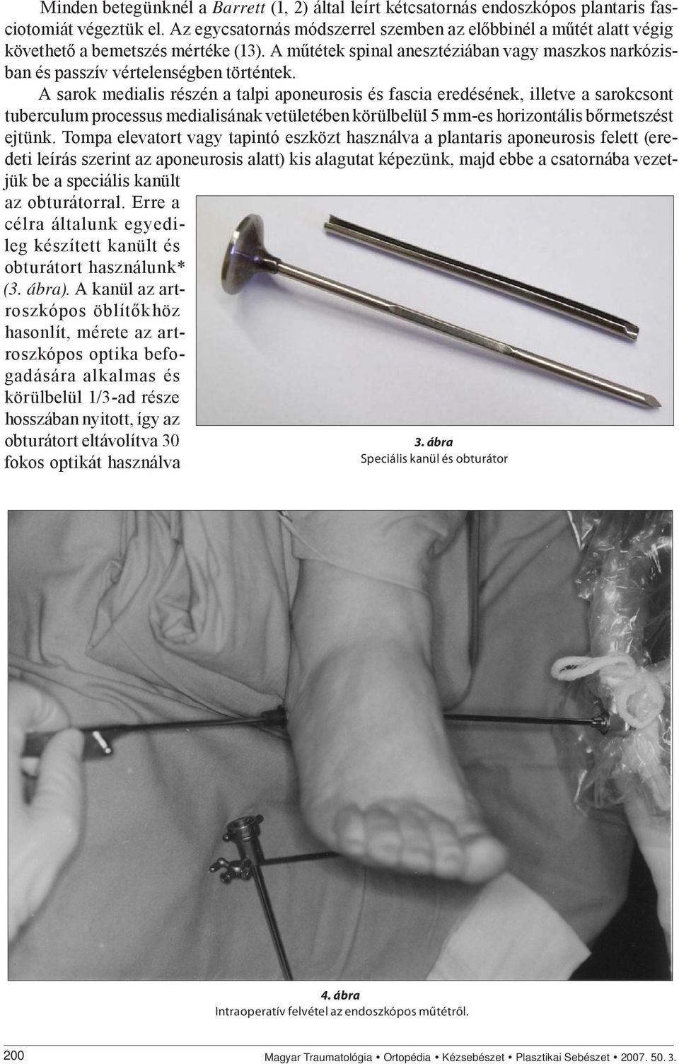 A sarok medialis részén a talpi aponeurosis és fascia eredésének, illetve a sarokcsont tuberculum processus medialisának vetületében körülbelül 5 mm-es horizontális bőrmetszést ejtünk.