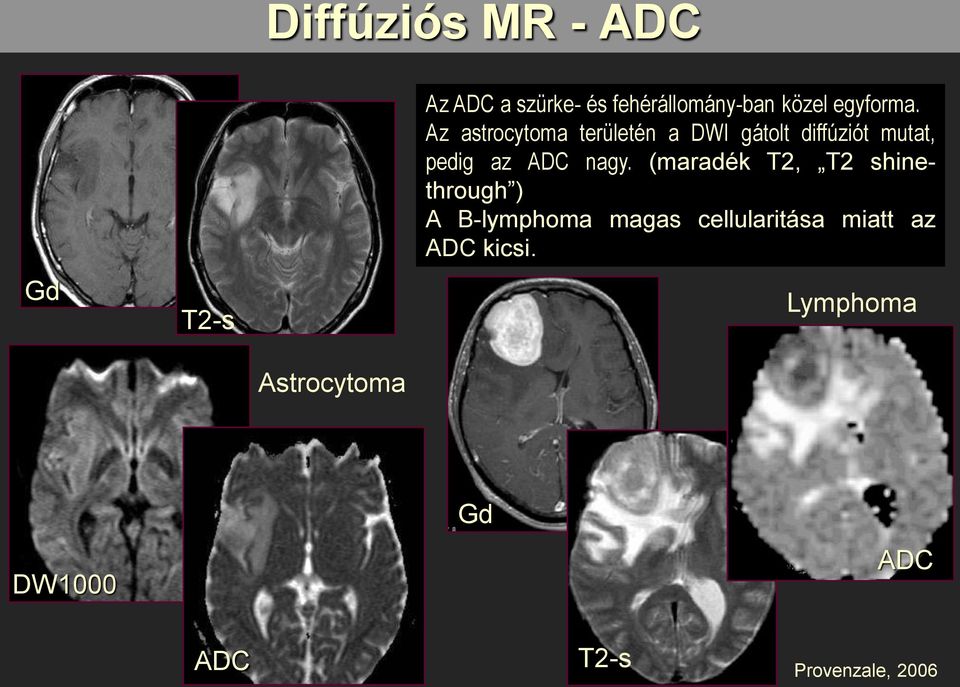 Az astrocytoma területén a DWI gátolt diffúziót mutat, pedig az ADC nagy.