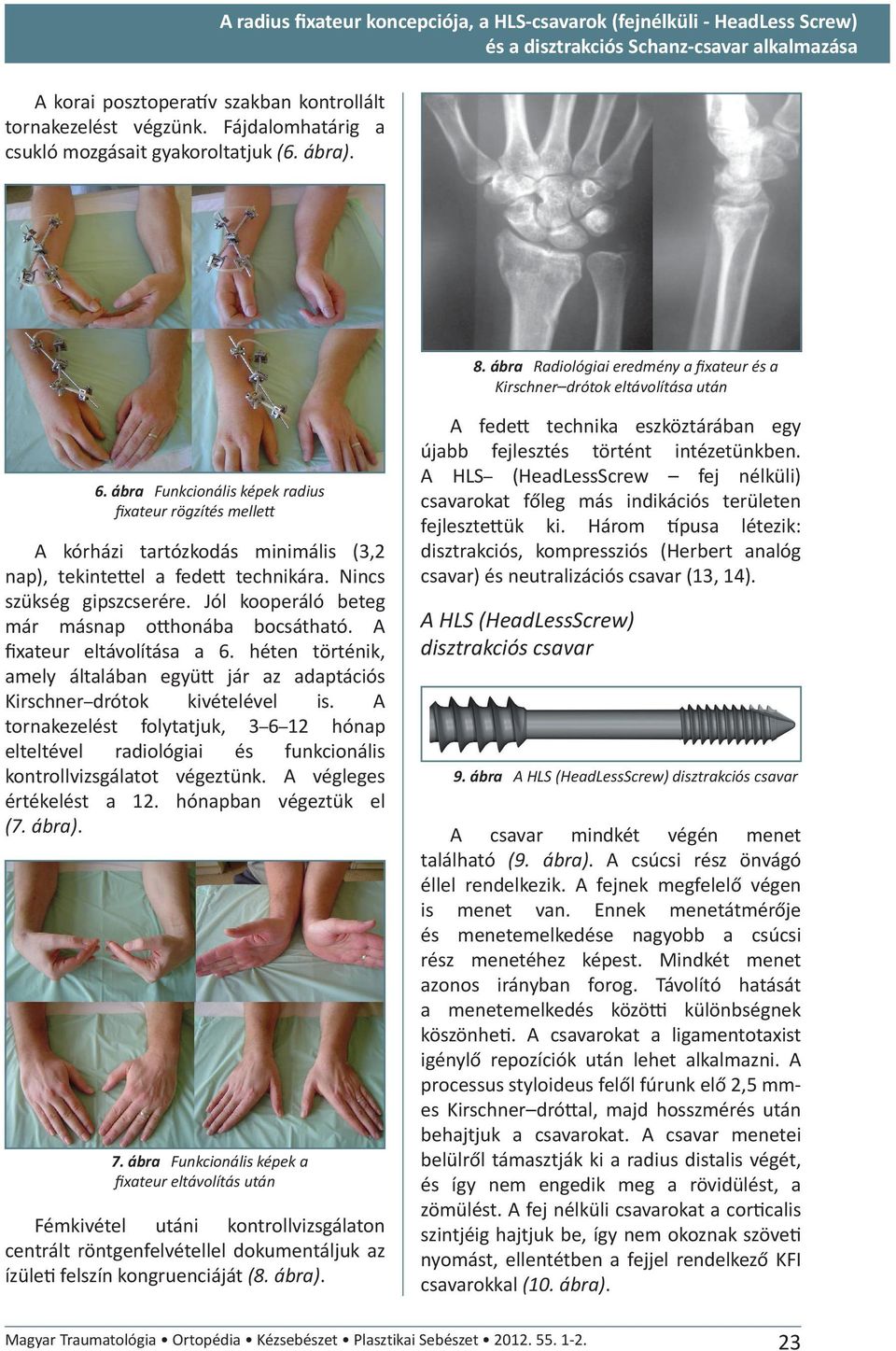 ábra Funkcionális képek radius fixateur rögzítés melle A kórházi tartózkodás minimális (3,2 nap), tekinteel a fede technikára. Nincs szükség gipszcserére.