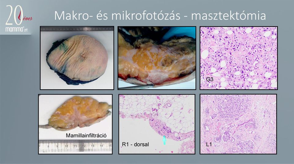 masztektómia G3