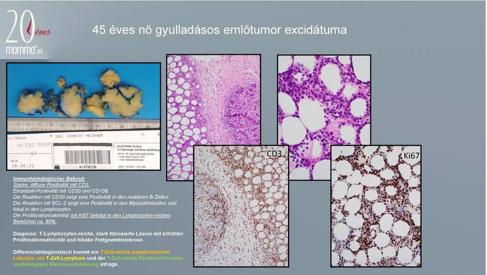 Die Proliferationsaktivität mit Ki67 beträgt in den Lymphozyten-reichen Bereichen ca. 80%.