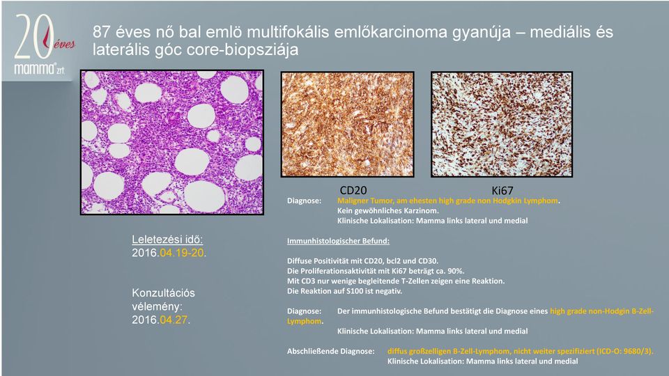 Immunhistologischer Befund: Diffuse Positivität mit CD20, bcl2 und CD30. Die Proliferationsaktivität mit Ki67 beträgt ca. 90%. Mit CD3 nur wenige begleitende T-Zellen zeigen eine Reaktion.