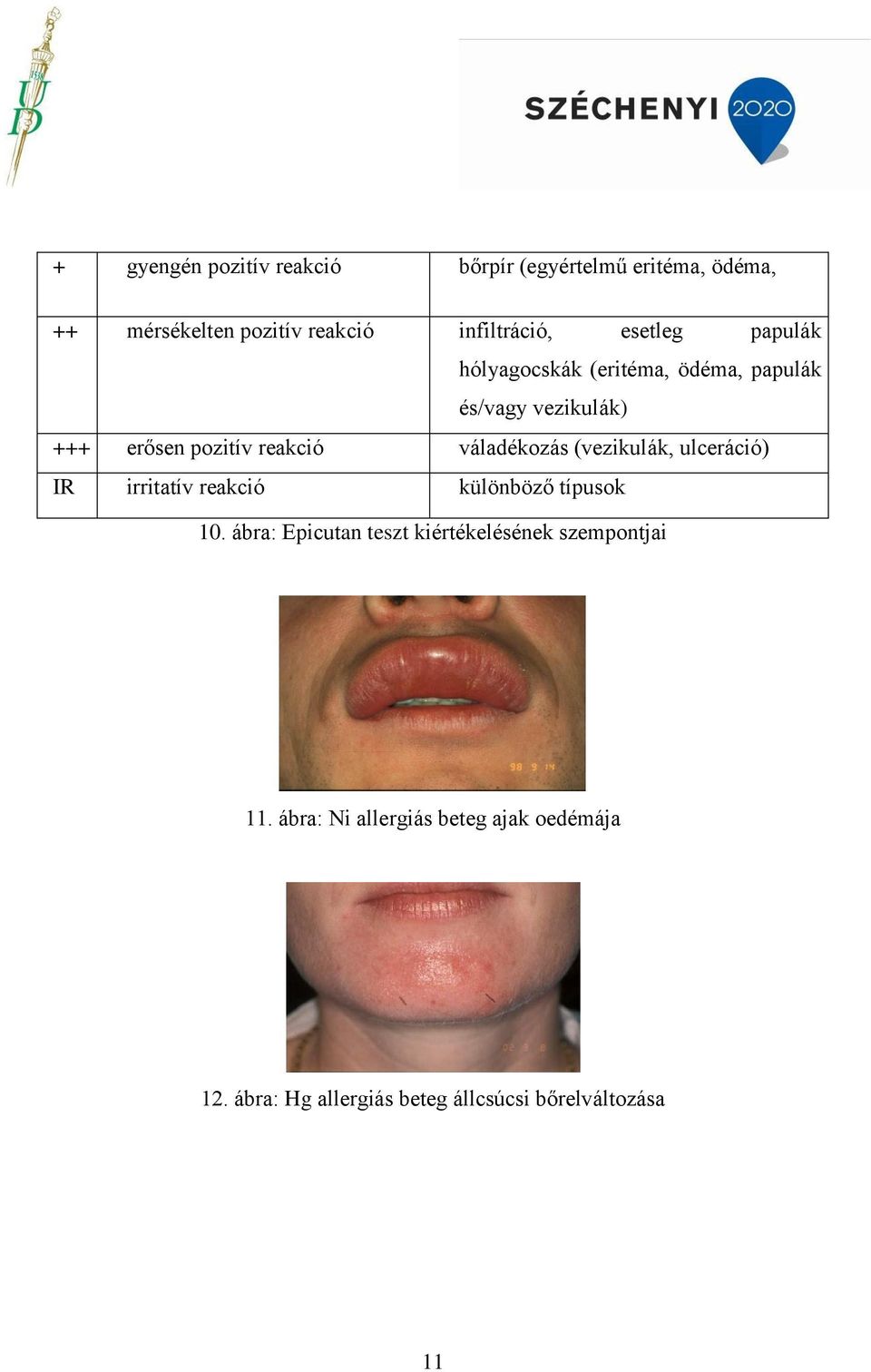 váladékozás (vezikulák, ulceráció) IR irritatív reakció különböző típusok 10.