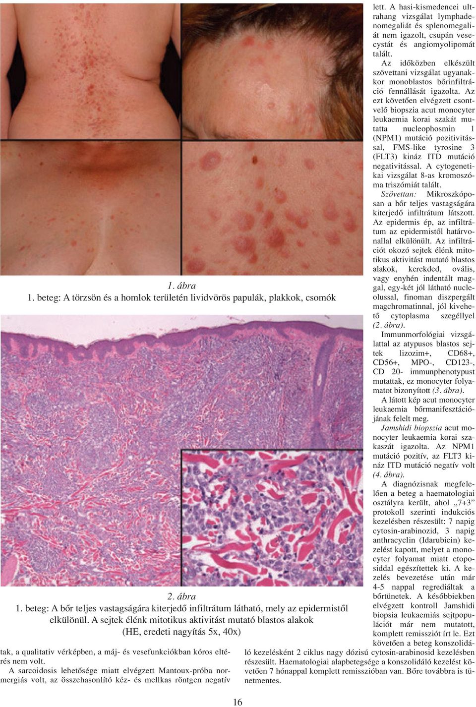 A sarcoidosis lehetôsége miatt elvégzett Mantoux-próba normergiás volt, az összehasonlító kéz- és mellkas röntgen negatív 16 lett.