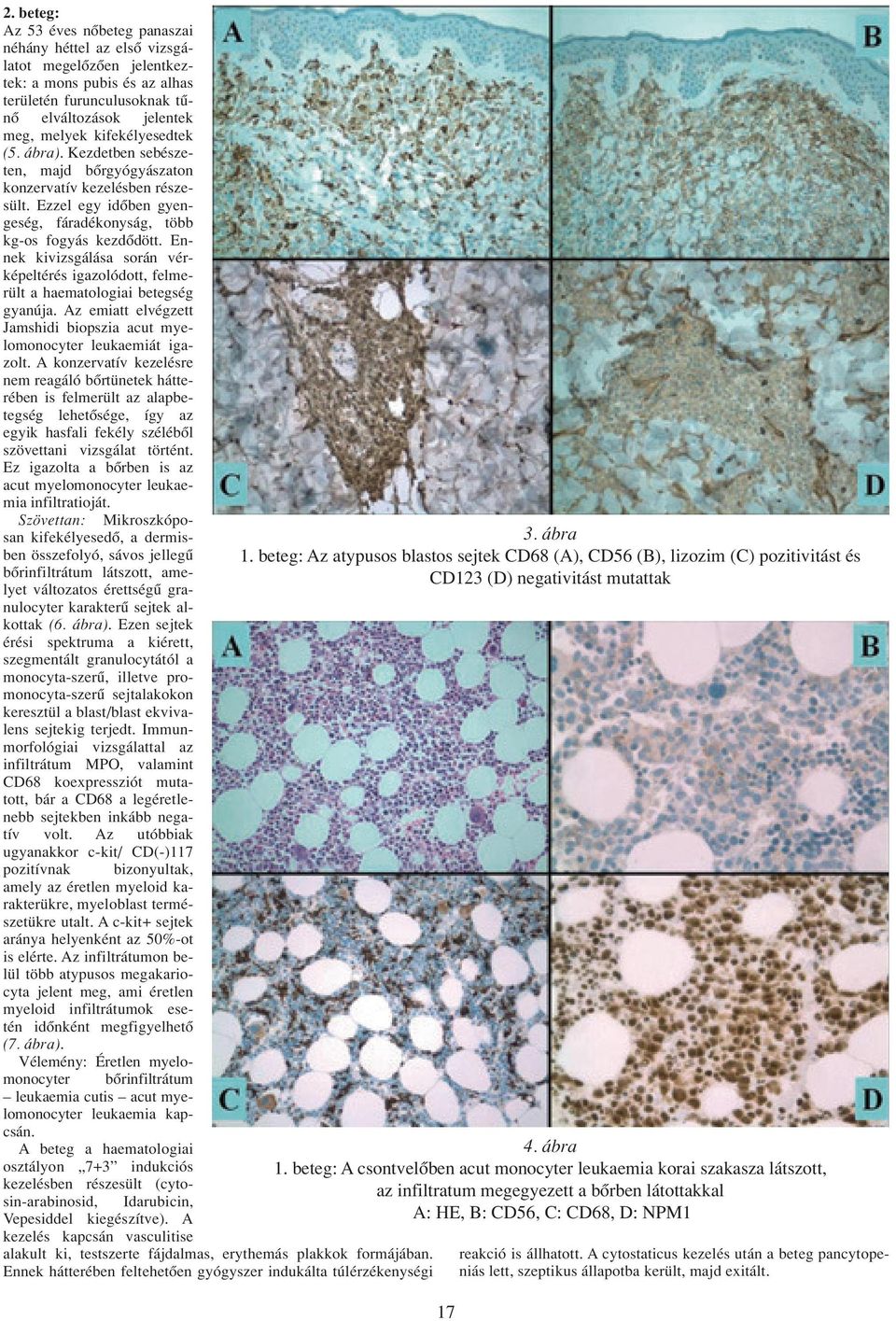 Ennek kivizsgálása során vérképeltérés igazolódott, felmerült a haematologiai betegség gyanúja. Az emiatt elvégzett Jamshidi biopszia acut myelomonocyter leukaemiát igazolt.