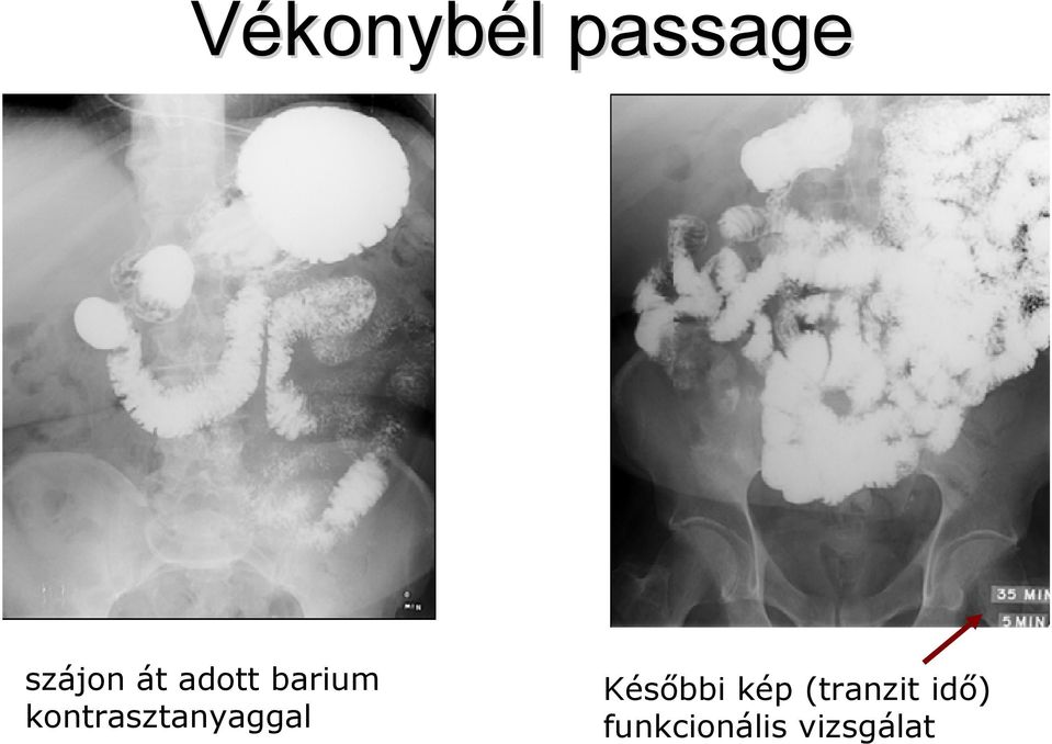 kontrasztanyaggal Későbbi