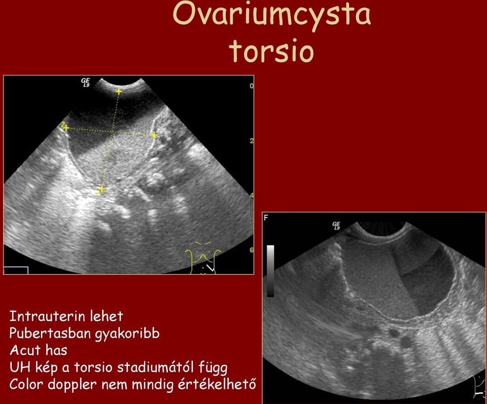 has UH kép a torsio stadiumától