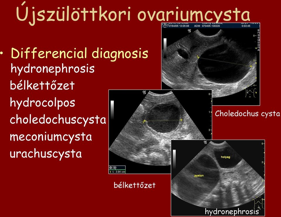 hydrocolpos choledochuscysta meconiumcysta