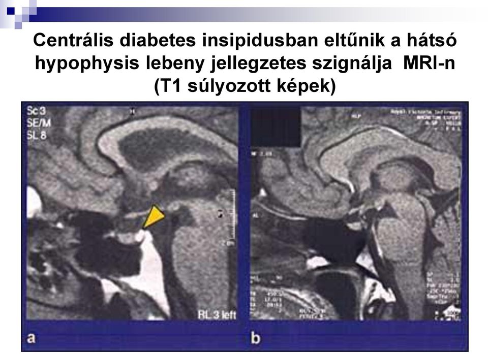 hypophysis lebeny