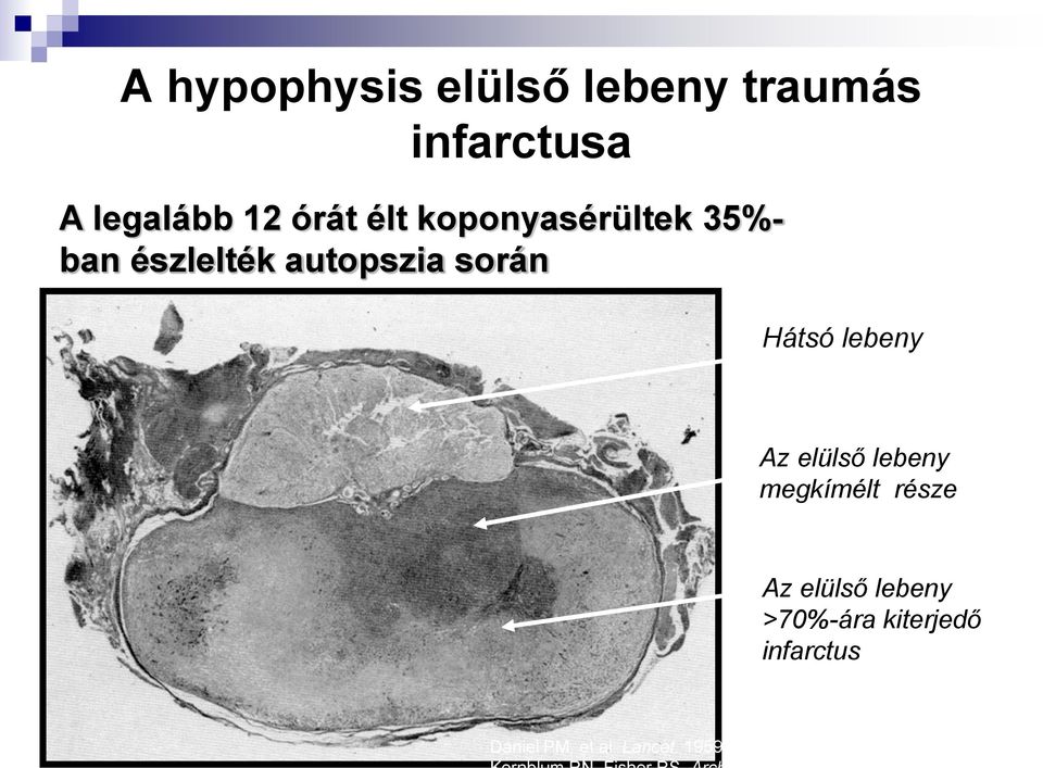 lebeny megkímélt része Az elülső lebeny >70%-ára kiterjedő infarctus Daniel