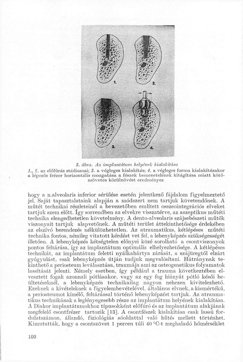 alveolaris inferior sérülése esetén jelentkező fájdalom figyelmeztető jel. Saját tapasztalataink alapján a módszert nem tartjuk követendőnek.