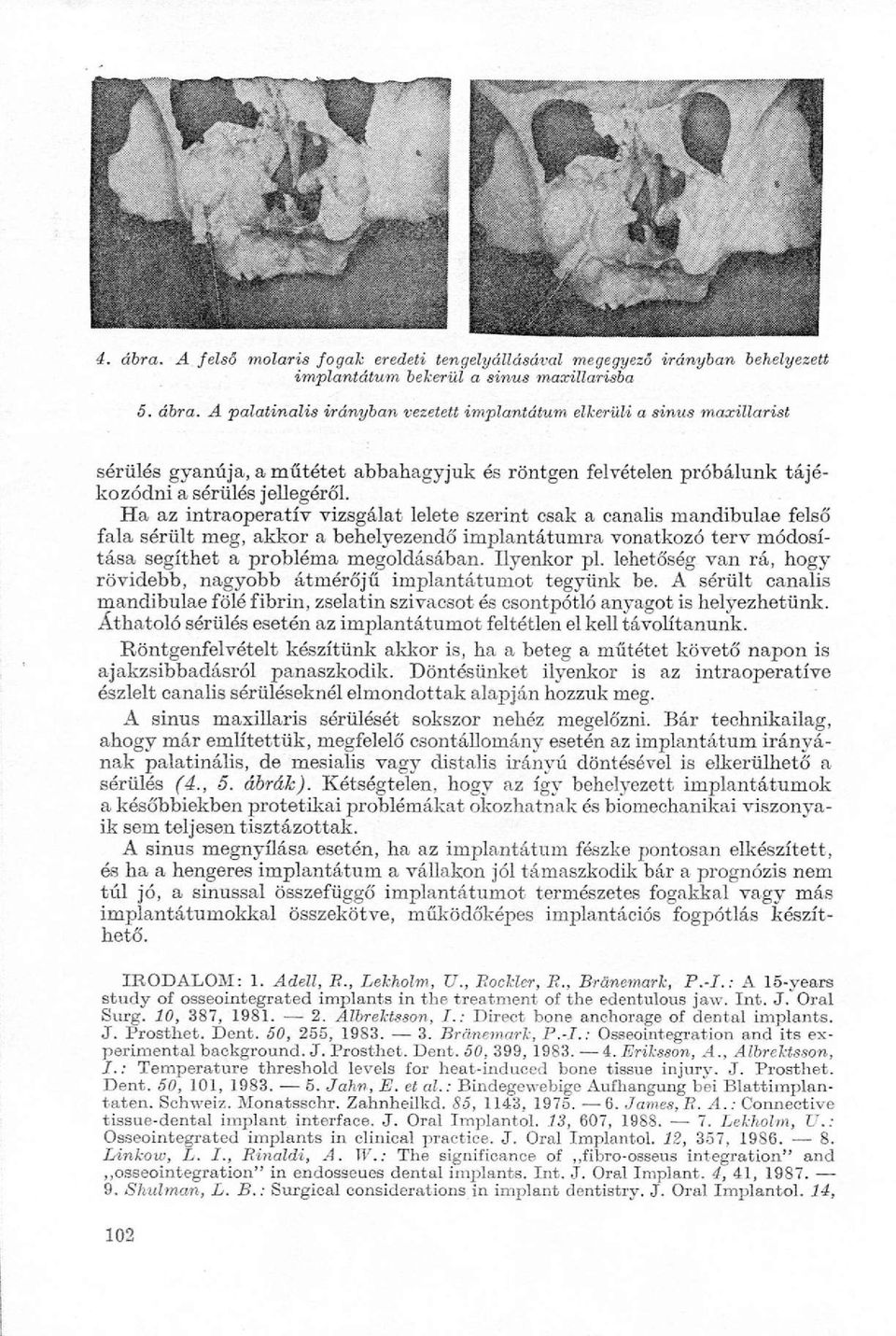 Ilyenkor pl. lehetőség van rá, hogy rövidebb, nagyobb átmérőjű implantátumot tegyünk be. A sérült canalis mandibulae fölé fibrin, zselatin szivacsot és csontpótló anyagot is helyezhetünk.