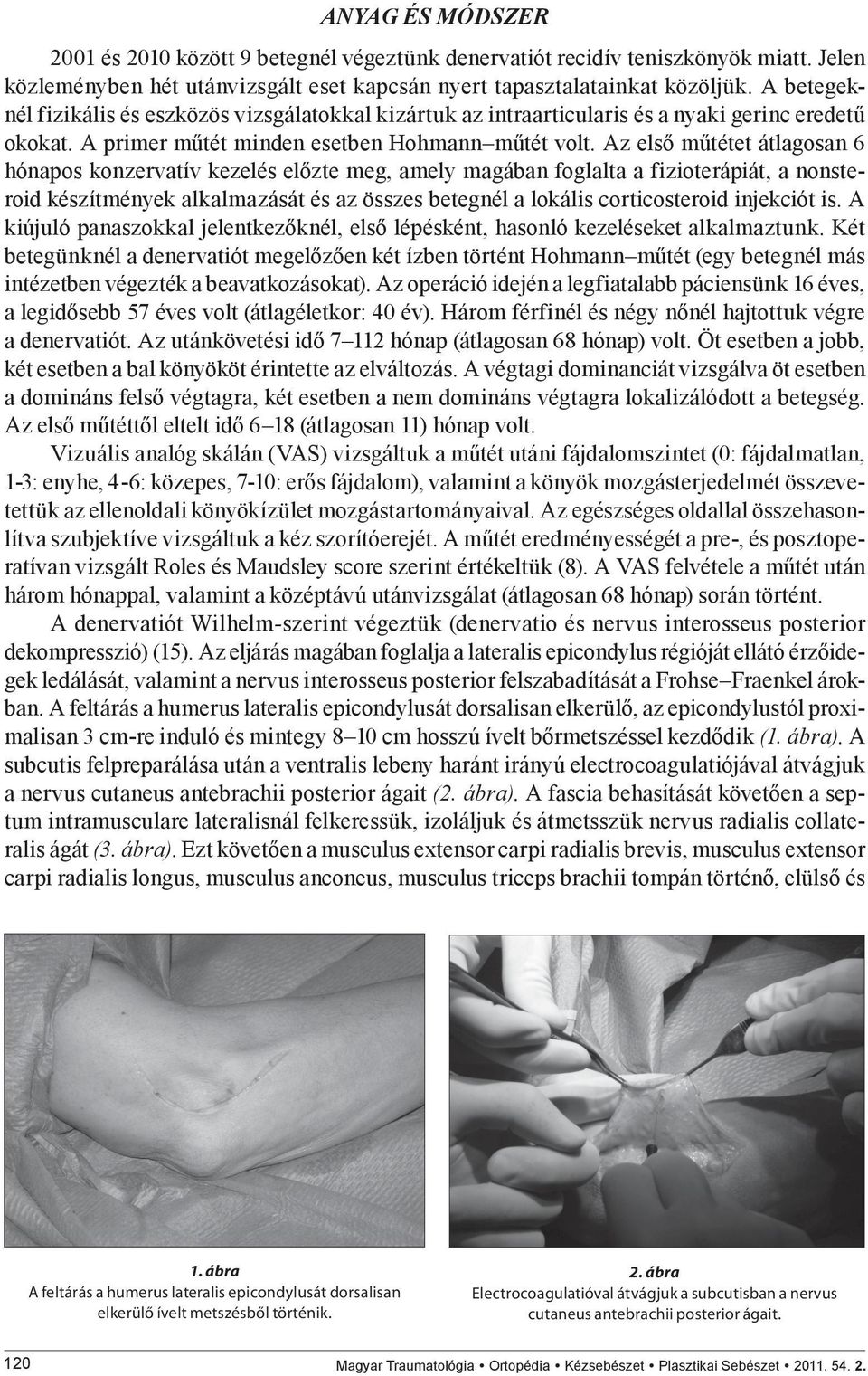 Az első műtétet átlagosan 6 hónapos konzervatív kezelés előzte meg, amely magában foglalta a fizioterápiát, a nonsteroid készítmények alkalmazását és az összes betegnél a lokális corticosteroid