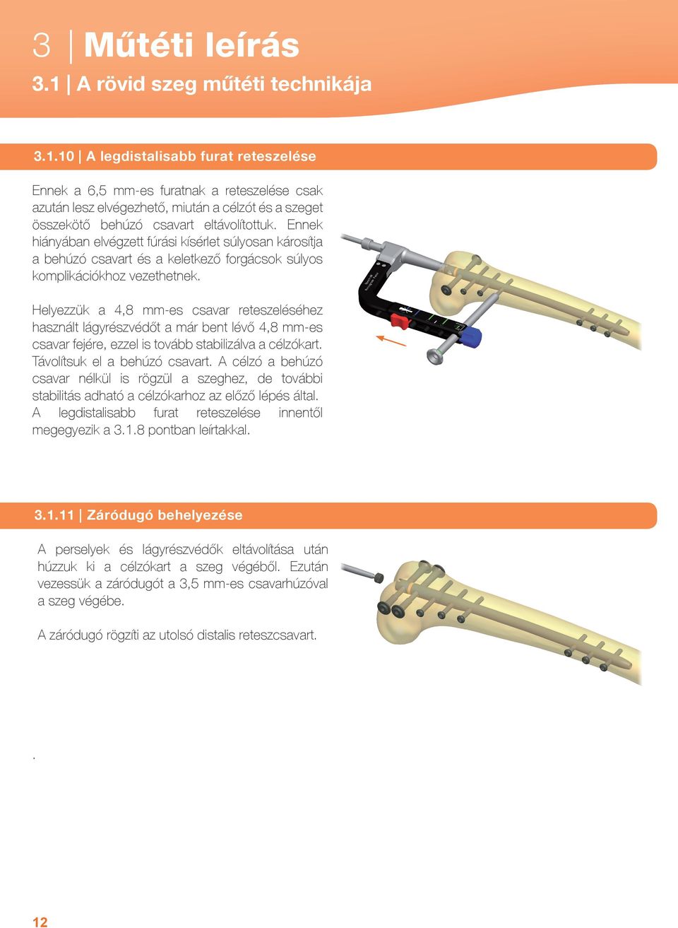 Helyezzük a 4,8 mm-es csavar reteszeléséhez használt lágyrészvédőt a már bent lévő 4,8 mm-es csavar fejére, ezzel is tovább stabilizálva a célzókart. Távolítsuk el a behúzó csavart.