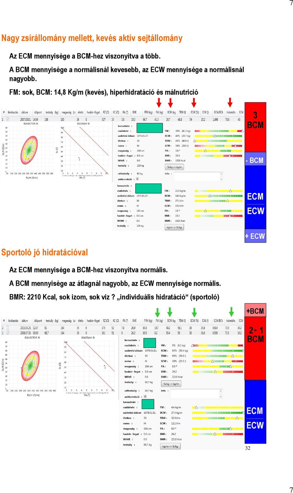 FM: sok, BCM: 14,8 Kg/m (kevés), hiperhidratáció és málnutrició 3 BCM - BCM ECM ECW + ECW 31 + ECW Sportoló jó hidratációval Az