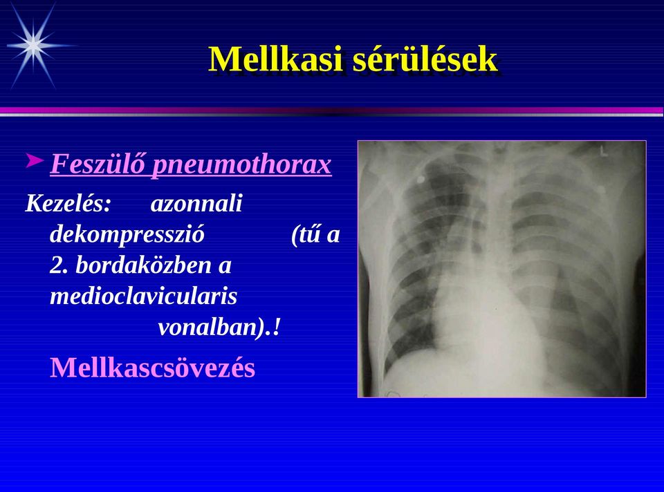 dekompresszió (tű a 2.