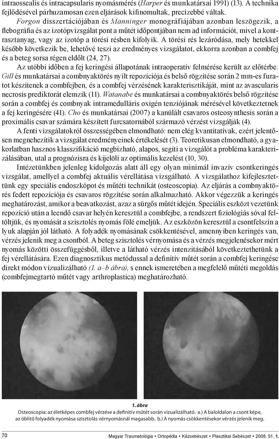 törési résben kifolyik. A törési rés lezáródása, mely hetekkel később következik be, lehetővé teszi az eredményes vizsgálatot, ekkorra azonban a combfej és a beteg sorsa régen eldőlt (24, 27).