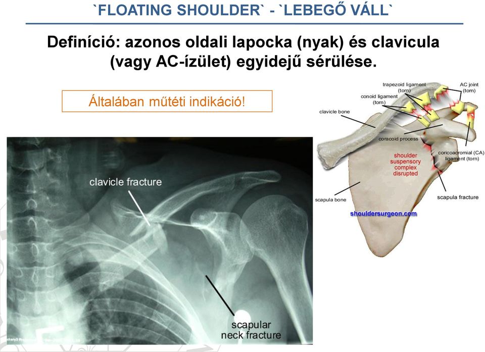 (nyak) és clavicula (vagy AC-ízület)