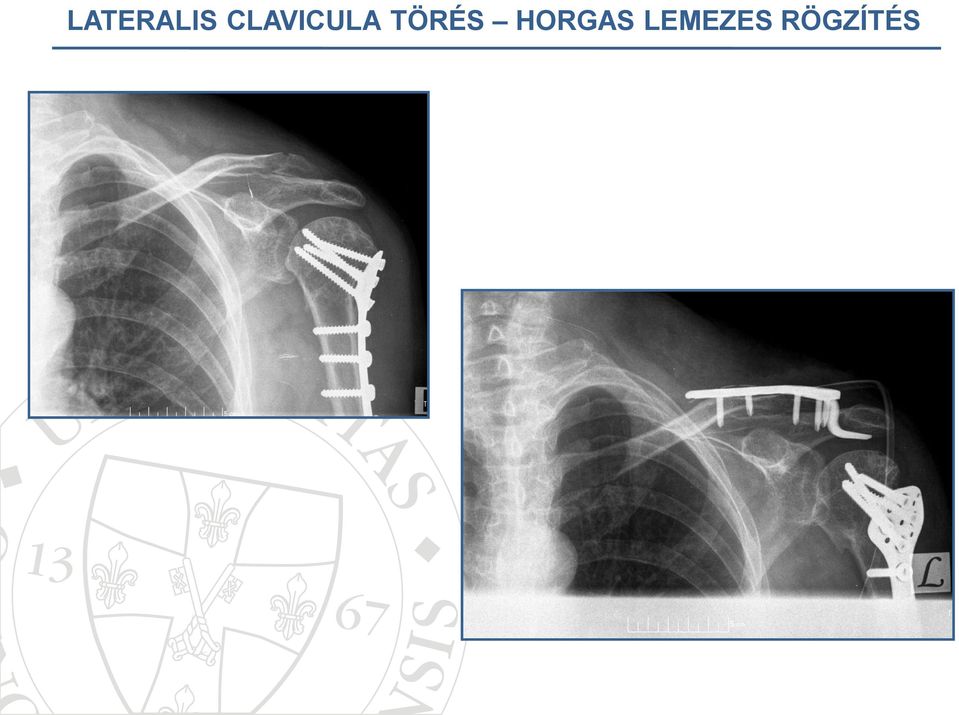 TÖRÉS HORGAS